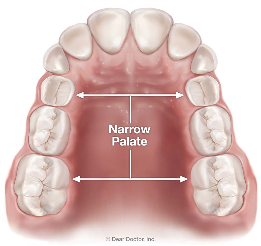 Narrow palate.